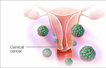 سرطان دهانه رحم و اهمیت آزمایش پاپ اسمیر: پیشگیری و تشخیص زودهنگام